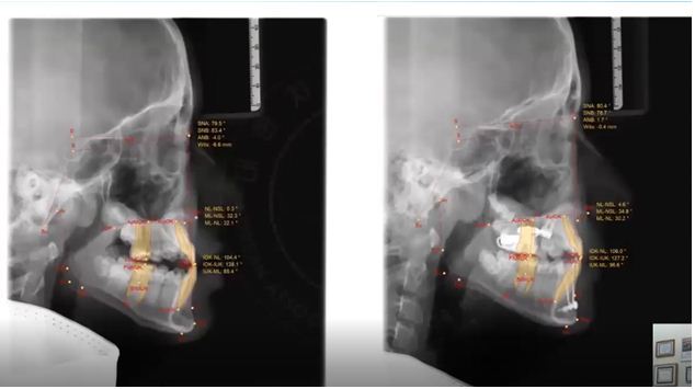 Chồng phim bằng CBCT và Cephalometric